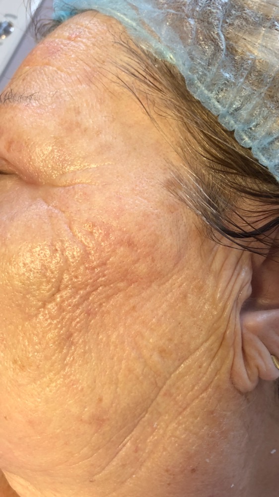 LIFTING S DERMAPAREM